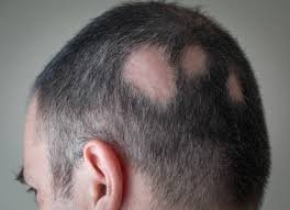 alopecia por celiaquia