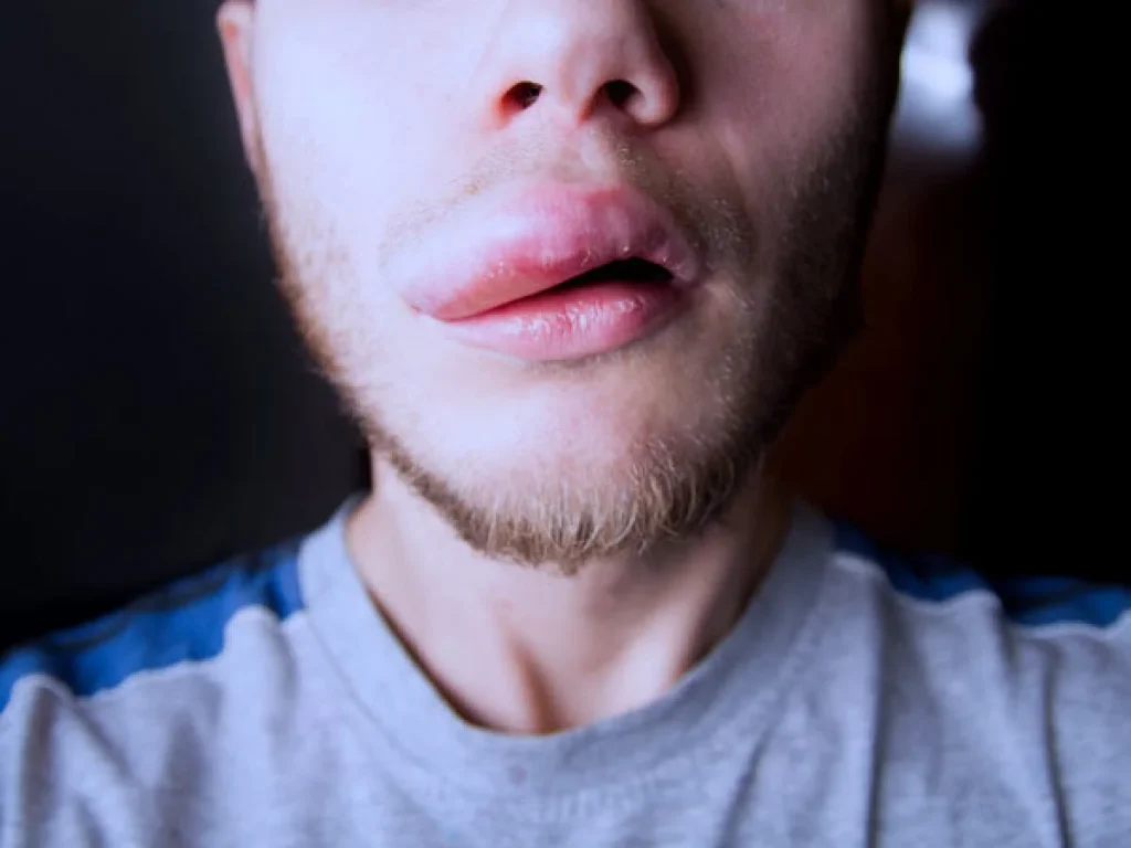 angioedema otra manifestación cutánea de la enfermedad celiaca