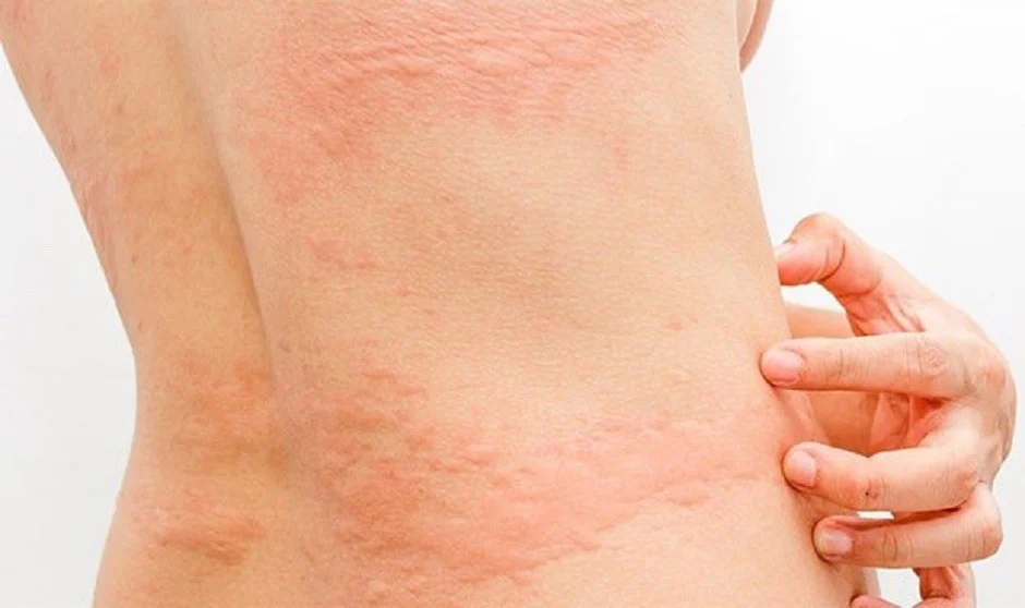 dermatitis herpetiforme en celiaquía