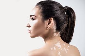 vitiligo manifestación cutánea por celiaquia