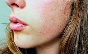 xerodermia o piel seca por la enf celiaca
